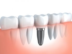 Jeremy J. Zobel, D.D.S. Zobel Dentistry, Dentist in Lansing, New York, tooth implant graphic